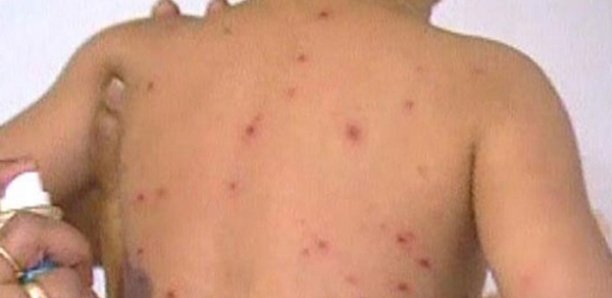 Épidémie de rougeole à Guédiawaye